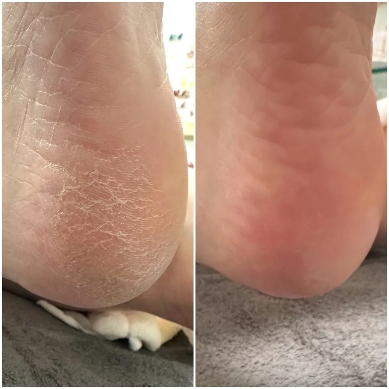 角質ケアリアルセミナー３月開催予定！